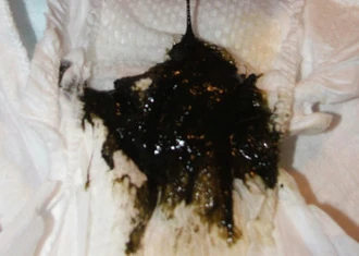 Meconium-poo Meconium poo